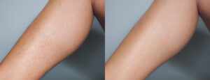 before and after leg wax